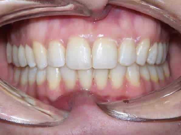 Deep Bite after orthodontic treatment