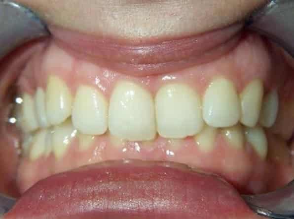 Deep Bite before orthodontic treatment