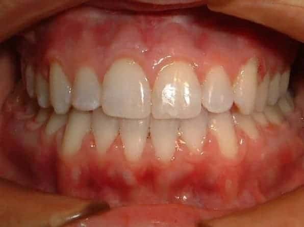 Edge-to-Edge Bite after orthodontic treatment