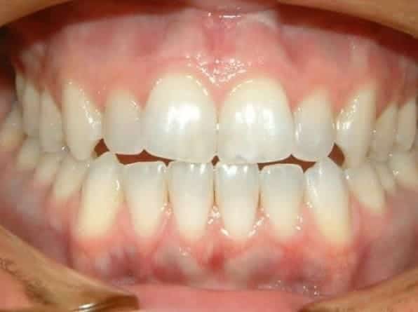 Edge-to-Edge Bite before orthodontic treatment