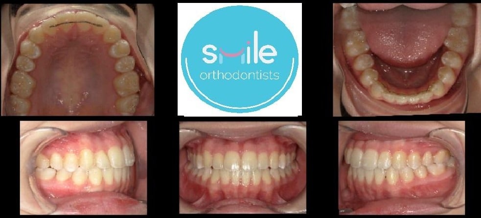 Mia teeth after orthodontic treatment
