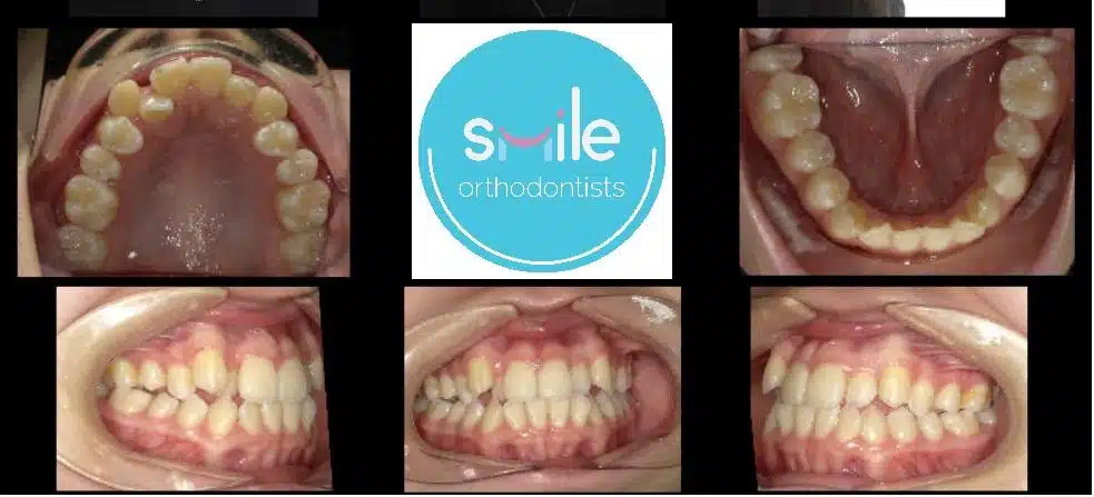 Mia teeth before orthodontic treatment