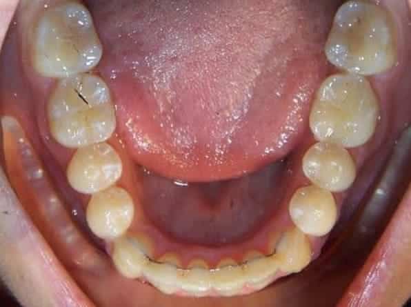 Lower Crowding after orthodontic treatment