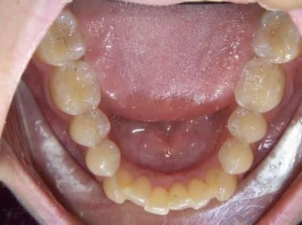 Lower Crowding before orthodontic treatment