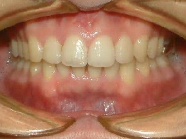Misaligned Teeth after orthodontic treatment