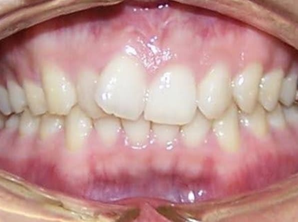 Misaligned Teeth before orthodontic treatment
