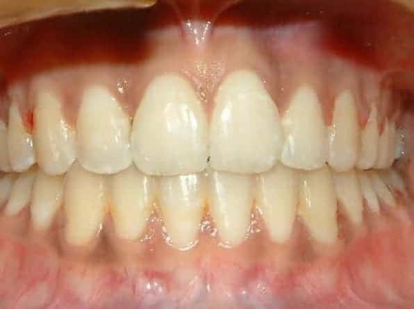 Open bite after orthodontic treatment