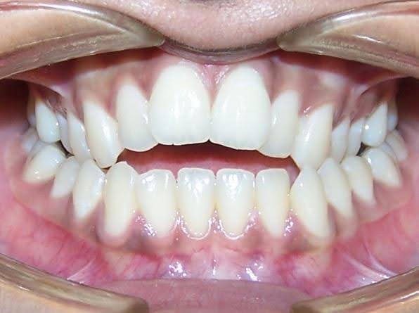 Open bite before orthodontic treatment