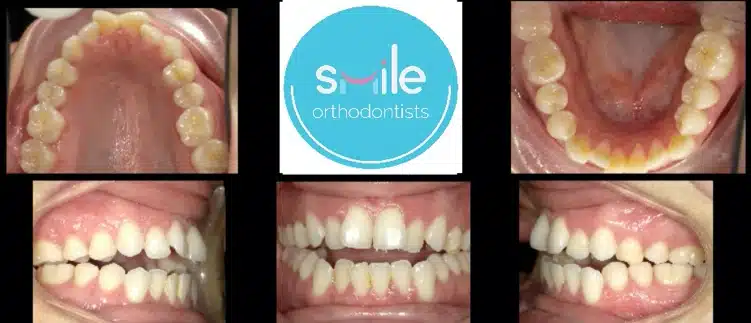 Franco teeth before orthodontic treatment