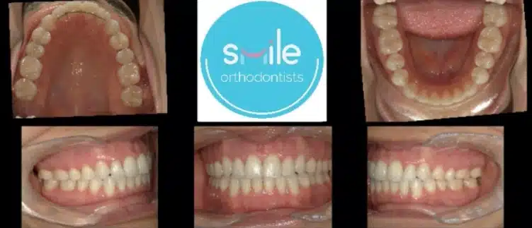 Franco teeth after orthodontic treatment