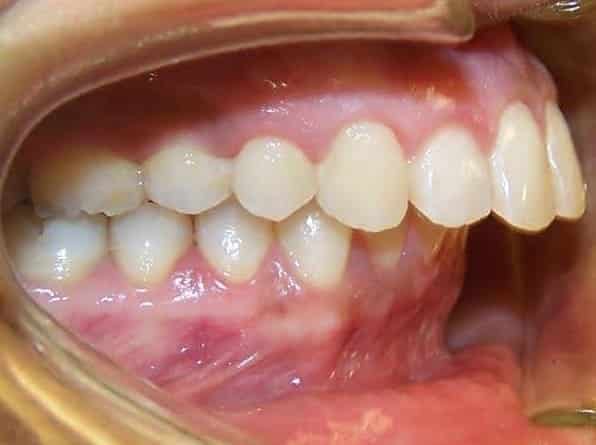 Overbite before orthodontic treatment