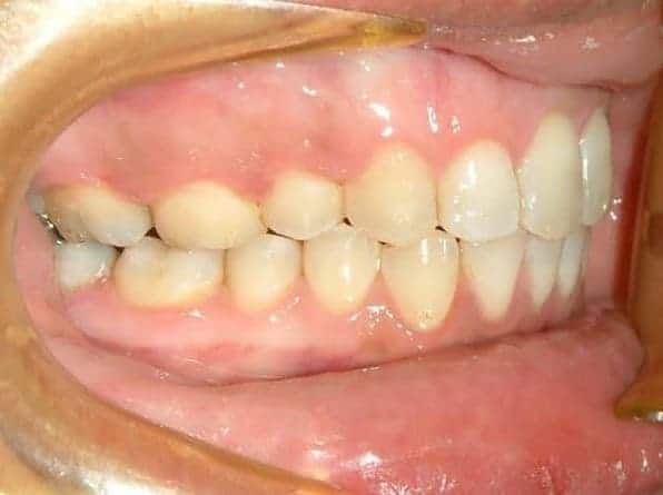 Overbite after orthodontic treatment
