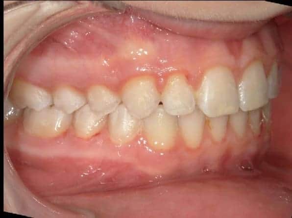 Overbite after orthodontic treatment