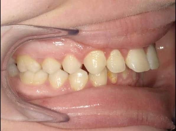 Overbite before orthodontic treatment
