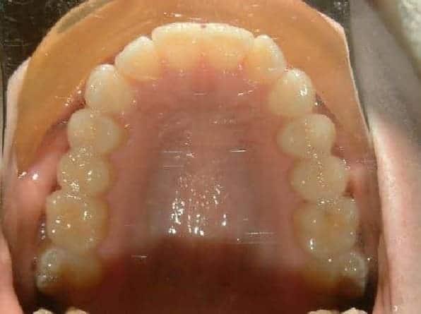 Overlapping Front Teeth after orthodontic treatment