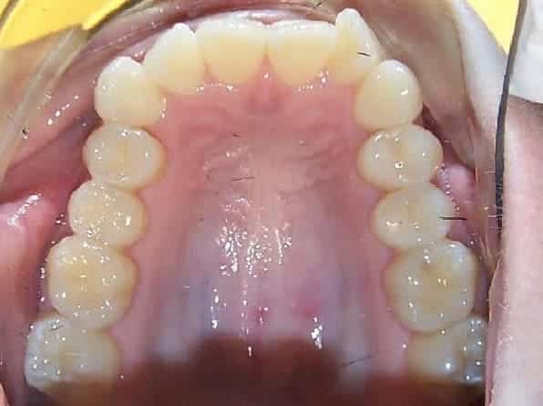 Overlapping Front Teeth before orthodontic treatment