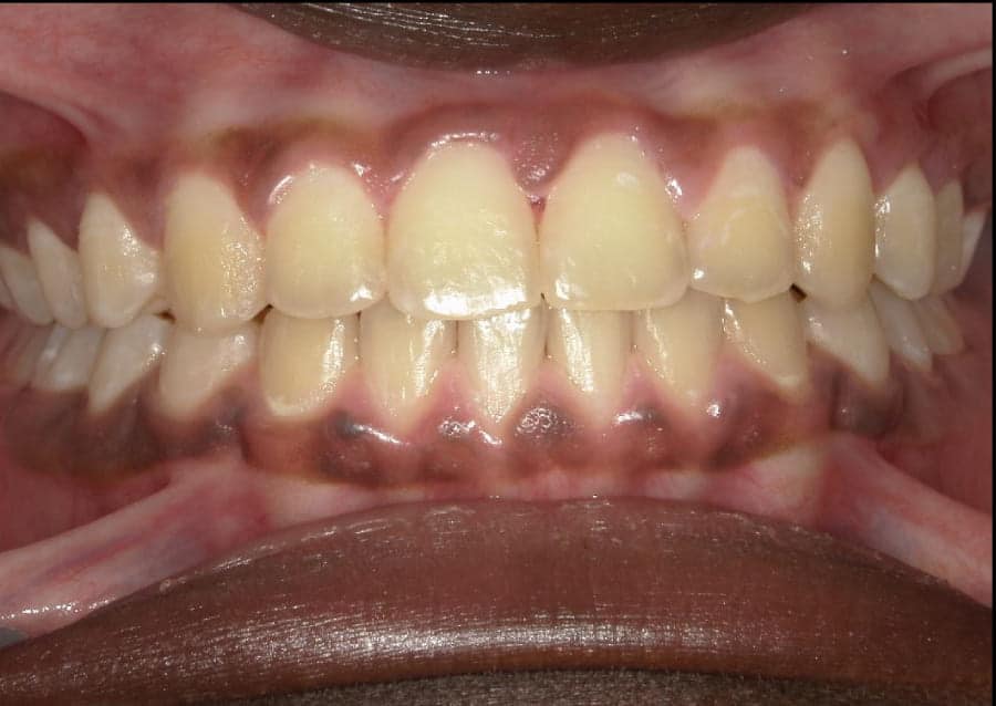 Penda teeth after orthodontic treatment