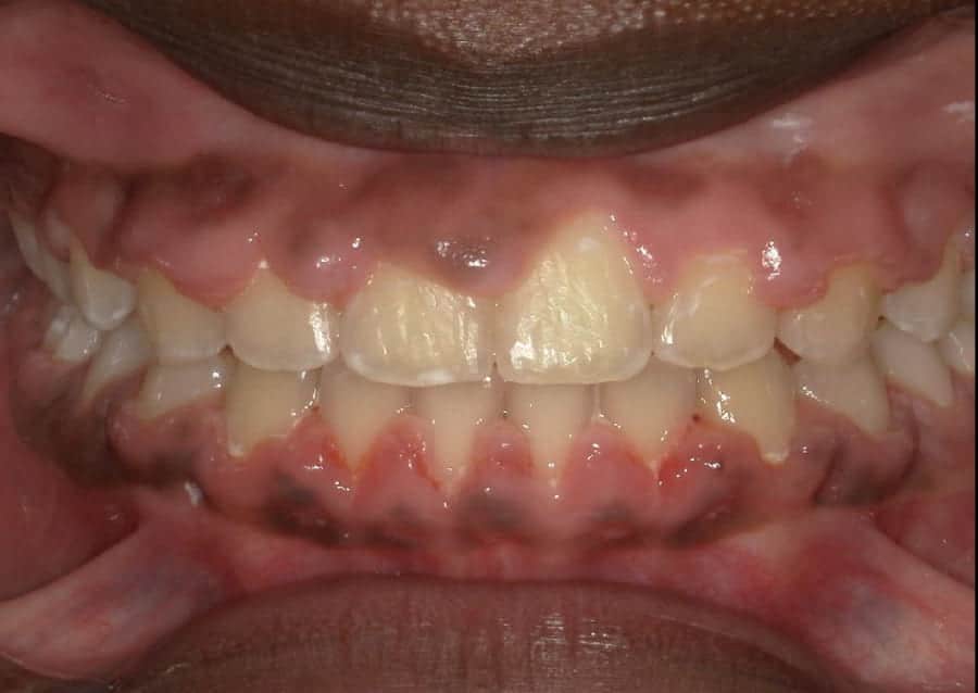 Penda teeth before orthodontic treatment