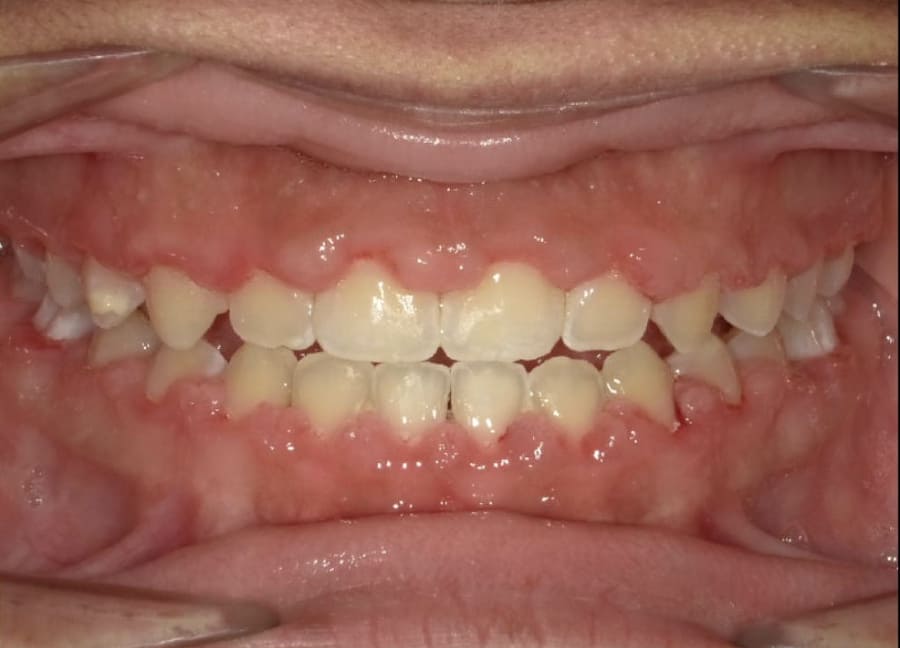 Pichardo teeth before orthodontic treatment