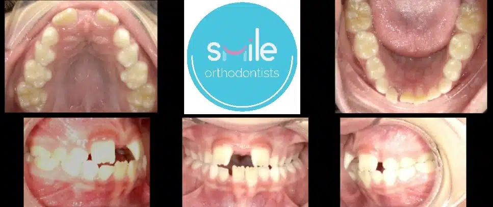 Erick teeth before orthodontic treatment