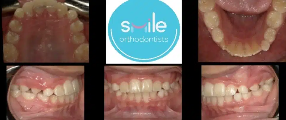 Erick teeth after orthodontic treatment
