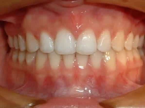 Spacing after orthodontic treatment