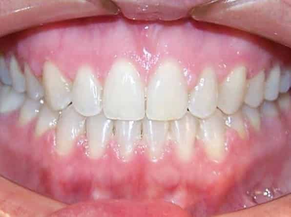 Spacing after orthodontic treatment