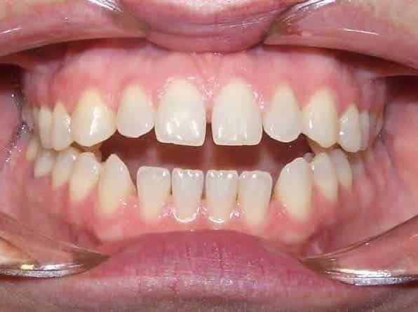 Spacing before orthodontic treatment