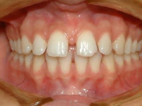 Spacing before orthodontic treatment