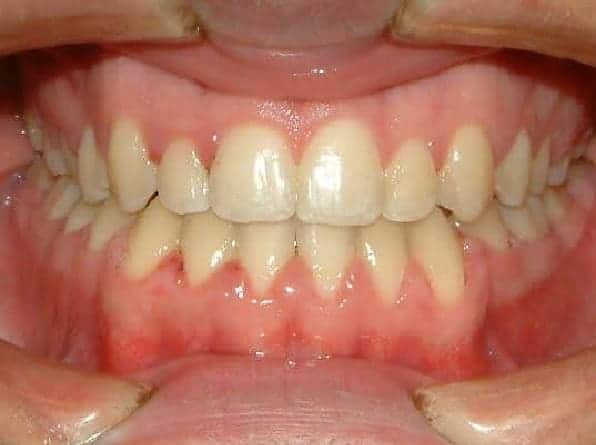 Underbite / Crossbite after orthodontic treatment
