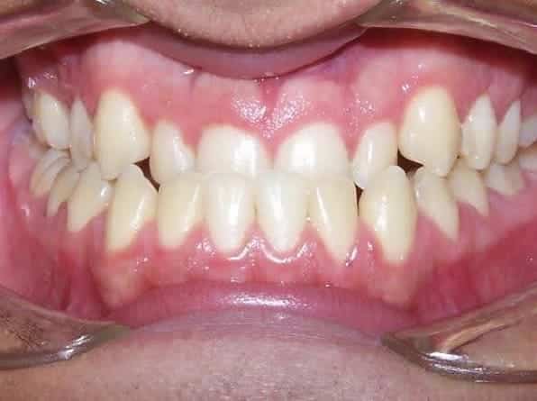 Underbite / Crossbite before orthodontic treatment